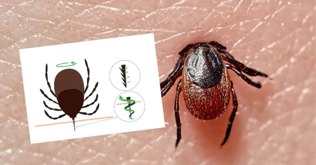 Co zrobić, gdy zostanie głowa kleszcza? Ważne informacje i ryzyko